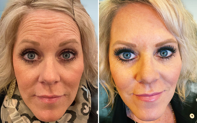 before and after botox front view Snoqualmie, WA Ageless Aesthetics