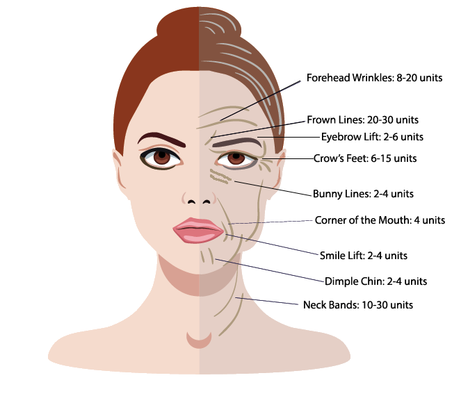 botox wrinkle units graphic