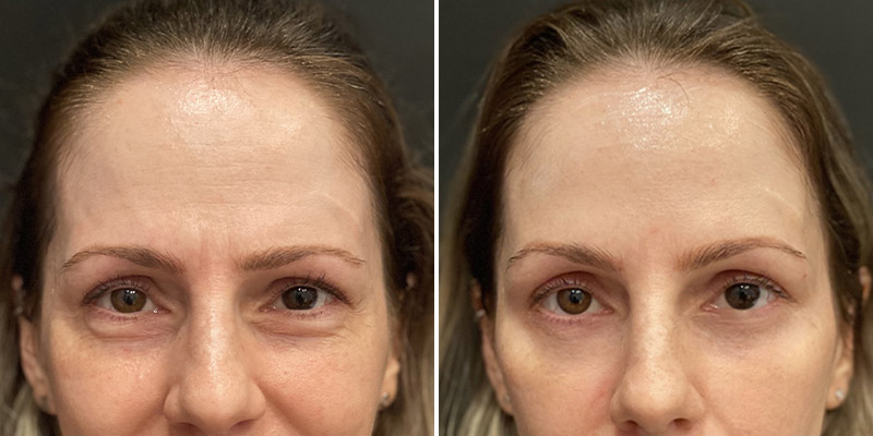 before and after botox front forehead view Snoqualmie, WA Ageless Aesthetics