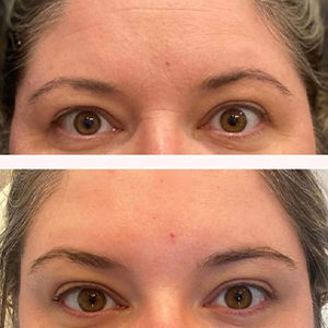 before and after botox front view Snoqualmie, WA Ageless Aesthetics