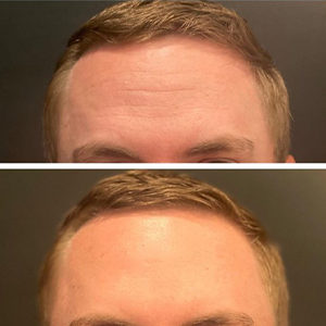 before and after botox front view Snoqualmie, WA Ageless Aesthetics