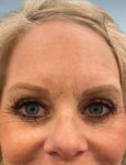 before botox front forehead view Snoqualmie, WA Ageless Aesthetics