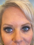 after botox front forehead view Snoqualmie, WA Ageless Aesthetics