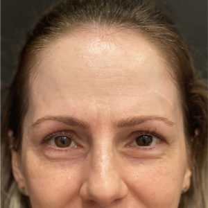 before botox front forehead view Snoqualmie, WA Ageless Aesthetics