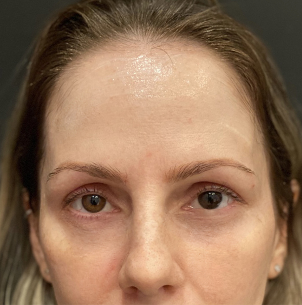 after botox front forehead view Snoqualmie, WA Ageless Aesthetics