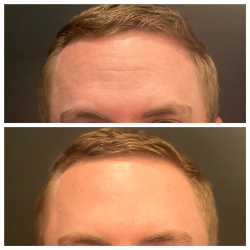 botox results Snoqualmie, WA Ageless Aesthetics