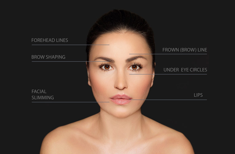 dermal filler location graphic