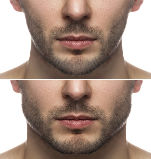 jaw line filler before and after